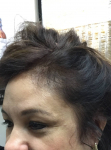 Hair Restoration Case 1 After